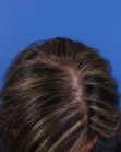 After Hair Transplant&nbsp;Hair Thinning